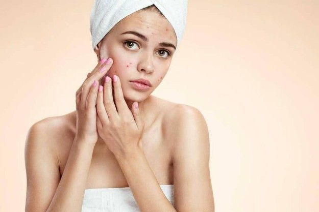 Acne Scars Treatment In Islamabad