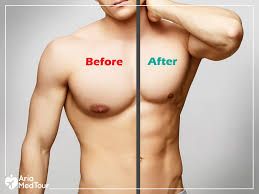 Gynecomastia Causes - The Causes of Man Breasts