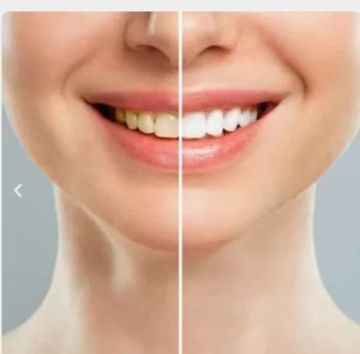 Teeth Whitening Ajman | Teeth Cleaning Ajman