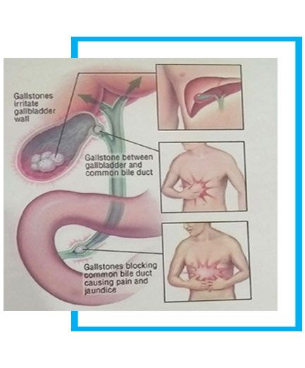  Laparoscopic Gallbladder Removal Surgery in New Delhi India